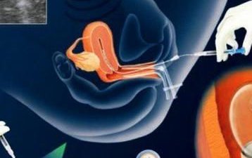 【试管指南】泰国试管婴儿费用大概由哪些部分组成的？